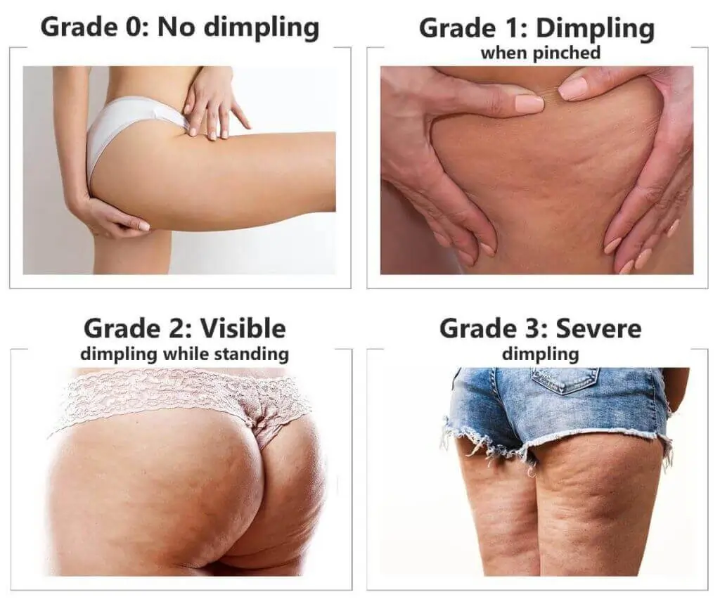 Representation of the stages of cellulite development Chippenham